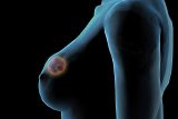 Podprsenka s ultrazvukem, která včas odhalí nádor. Nigerijská podnikatelka ji vymyslela po smrti tety