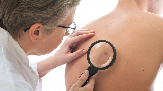 Jak vzniká kožní nádor a jak se dnes léčí? Každý milimetr má vliv